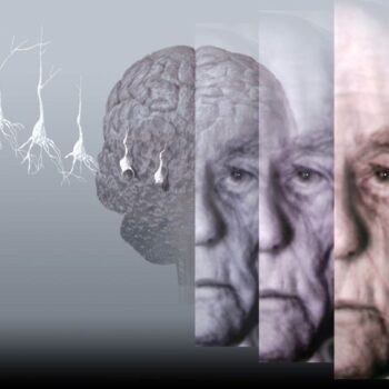 Alzheimer disease