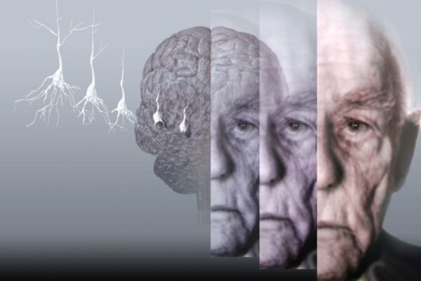 Alzheimer disease