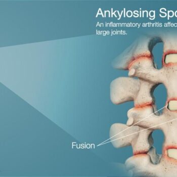 Ankylosing spondylitis