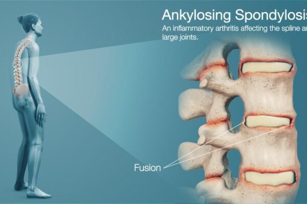 Ankylosing spondylitis