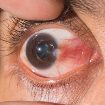 رتینوبلاستوما (Retinoblastoma)