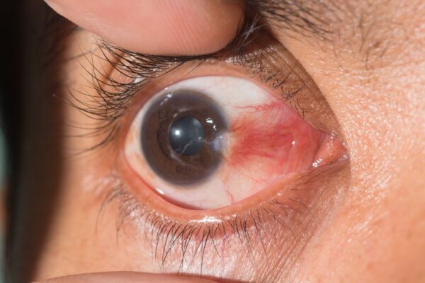 رتینوبلاستوما (Retinoblastoma)