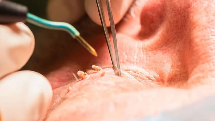 زاه های درمان زگیل تناسلی