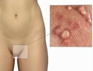 تشخیص HPV در خانه