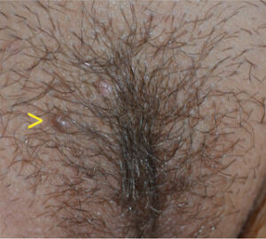 عکس برجستگی کوچک پوستی در ناحیه پرمو که ممکن است با زگیل تناسلی اشتباه گرفته شود