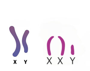 سندرم کلاین فلتر یا XXY به معنی وجود یک کروموزوم اضافه در محتوای ژنتیکی سلول است.
