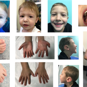 سندرم اسمیت_لملی_اوپیتز( Smith-Lemli-Opitz Syndrome یا SLOS )