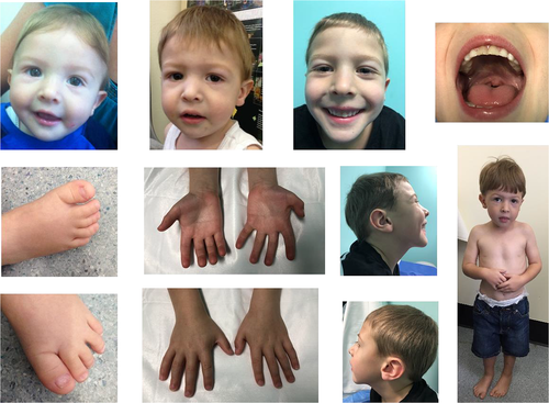 سندرم اسمیت_لملی_اوپیتز( Smith-Lemli-Opitz Syndrome یا SLOS )