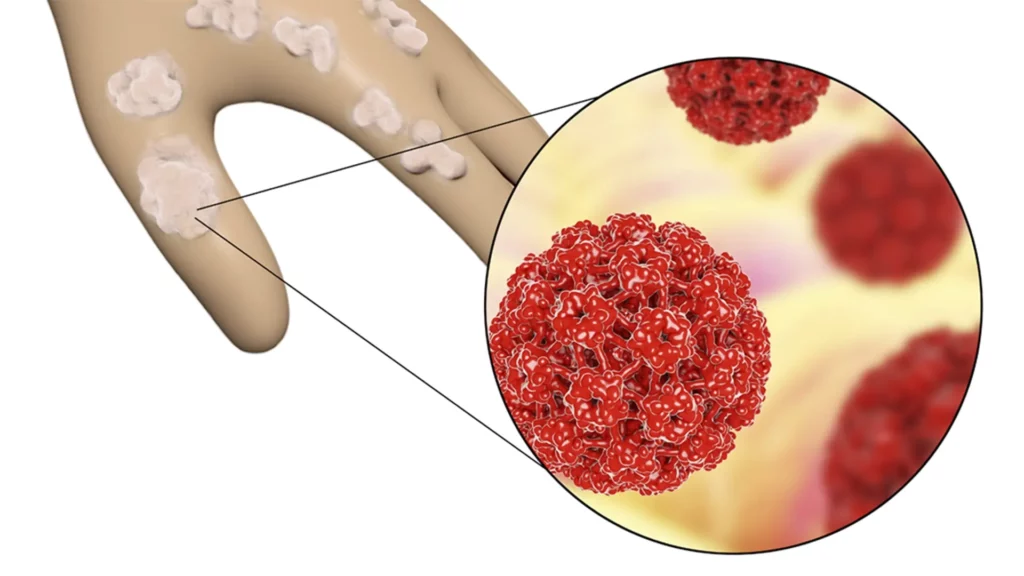 انتقال ویروس hpv