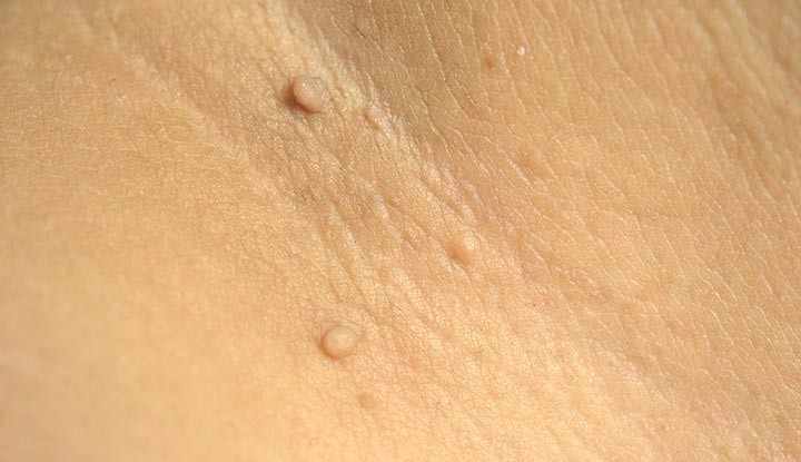 زگیل تناسلی ریز